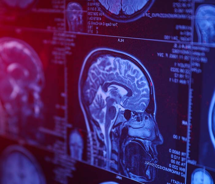 image of brain scan